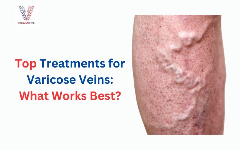 Top Treatments for Varicose Veins: What Works Best?